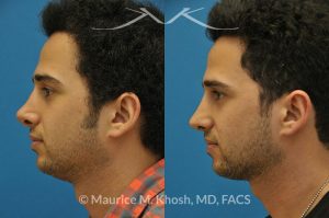 Photo of a patient before and after a procedure. Previous rhinoplasty in this young man had been a failure. The tip was raised too high, the nose was too short, and the tip was pinched. Revision rhinoplasty via the open approach successfully addressed the abnormalities and rendered the nose more aesthetic and natural in its appearance.