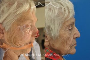 Photo of a patient before and after a procedure. Nose Moh's skin cancer repair, utilizing forehead flap and ear cartilage graft