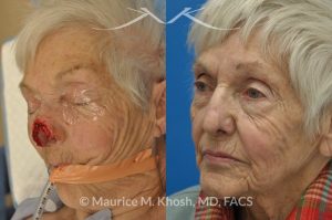 Photo of a patient before and after a procedure. Nose Moh's skin cancer repair, utilizing forehead flap and ear cartilage graft