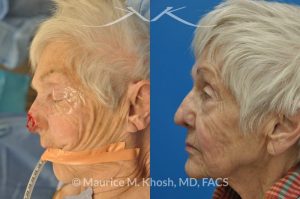 Photo of a patient before and after a procedure. Nose Moh's skin cancer repair, utilizing forehead flap and ear cartilage graft