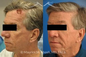 Photo of a patient before and after a procedure. Repair of forehead basal cell skin cancer defect after Mohs excision