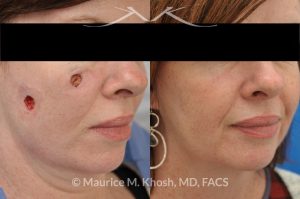 Photo of a patient before and after a procedure. Repair of cheek basal cell skin cancer defect after Mohs excision