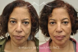 Photo of a patient before and after a procedure. Botox injection of frown lines and the chin, Restylane treatment of the cheeks and marionette lines