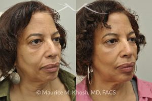 Photo of a patient before and after a procedure. Botox injection of frown lines and the chin, Restylane treatment of the cheeks and marionette lines