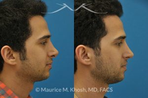 Photo of a patient before and after a procedure. Revision rhinoplasty via the open approach - Previous rhinoplasty in this young man had been a failure. The tip was raised too high, the nose was too short, and the tip was pinched. Revision rhinoplasty via the open approach successfully addressed the abnormalities and rendered the nose more aesthetic and natural in its appearance.