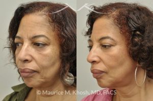 Photo of a patient before and after a procedure. Botox injection of frown lines and the chin, Restylane treatment of the cheeks and marionette lines