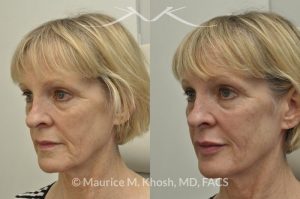 Photo of a patient before and after a procedure. Juavderm facial filler injection of cheeks, lips and orbital hollows