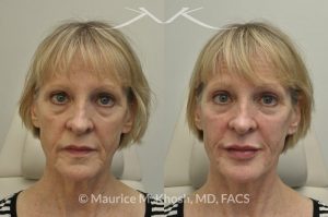 Photo of a patient before and after a procedure. Juavderm facial filler injection of cheeks, lips and orbital hollows