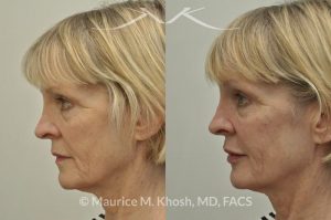 Photo of a patient before and after a procedure. Juavderm facial filler injection of cheeks, lips and orbital hollows