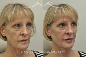 Photo of a patient before and after a procedure. Juavderm facial filler injection of cheeks, lips and orbital hollows