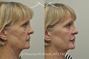 Photo of a patient before and after a procedure. Juavderm facial filler injection of cheeks, lips and orbital hollows
