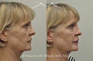 Photo of a patient before and after a procedure. Juavderm facial filler injection of cheeks, lips and orbital hollows