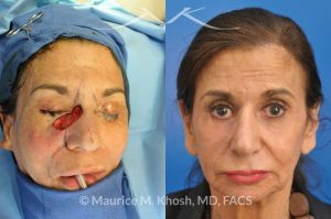 Photo of a patient before and after a procedure. Repair of squamous cell skin cancer of nose and lower eyelid with forehead flap - before and after photos.
