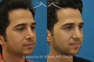 Photo of a patient before and after a procedure. Revision rhinoplasty via the open approach - Previous rhinoplasty in this young man had been a failure. The tip was raised too high, the nose was too short, and the tip was pinched. Revision rhinoplasty via the open approach successfully addressed the abnormalities and rendered the nose more aesthetic and natural in its appearance.