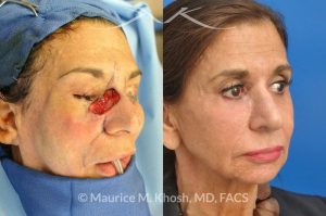 Photo of a patient before and after a procedure. Repair of squamous cell skin cancer of nose and lower eyelid with forehead flap - before and after photos.