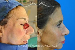 Photo of a patient before and after a procedure. Repair of squamous cell skin cancer of nose and lower eyelid with forehead flap - before and after photos.