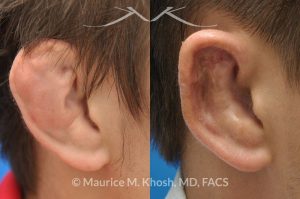 Photo of a patient before and after a procedure. Repair of Cauliflower Ear Deformity, Wrestler's Ear Deformity