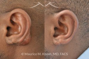 Photo of a patient before and after a procedure. Keloid scar of left ear (auricle), excision and repair of ear keloid
