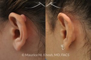 Photo of a patient before and after a procedure. Excison and repair of keloid on the upper part of the ear (auricle)