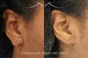 Photo of a patient before and after a procedure. Keloid of earlobe, excision and repair of keloid