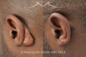 Photo of a patient before and after a procedure. Keloid scar of left ear (auricle), excision and repair of ear keloid