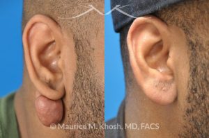 Photo of a patient before and after a procedure. Keloid scar removal right earlobe