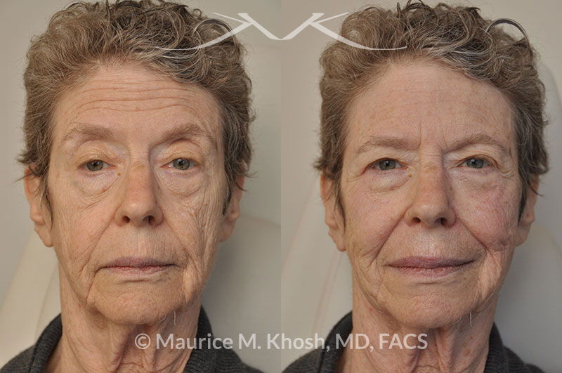Non-Surgical Facelift New York, NY