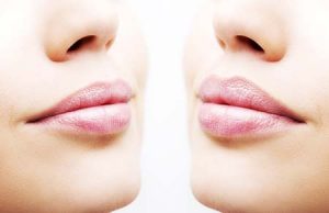 New York NY Lip Enhancement Treatments