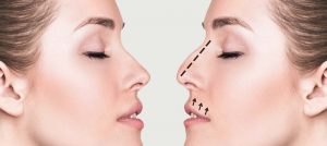 New York NY Surgeon for Revision Nose Job