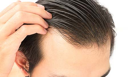 Male scalp.