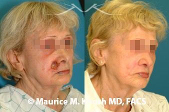 Skin defect at junction of the cheek and lip removed by Mohs surgery