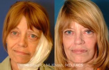Facial Paralysis Treatment New York, NY