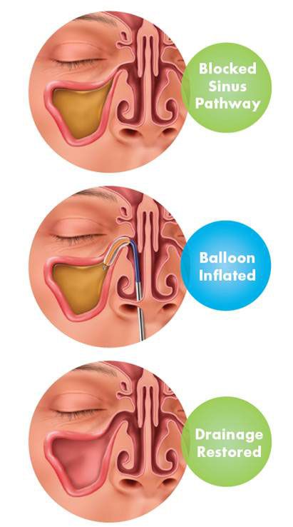 Blocked Sinus Pathway, Balloon Inflated Drainange restored