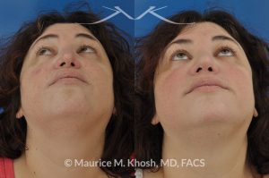 Photo of a patient before and after a procedure. Nasal valve repair - Nasal valve repair (repair of nasal vestibular stenosis) with rib cartilage graft.