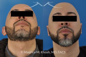 Photo of a patient before and after a procedure. Ear pinning (otoplasty) - to address protubernt ears or prominent ears.