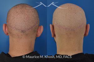 Photo of a patient before and after a procedure. Ear pinning (otoplasty) - to address protubernt ears or prominent ears.