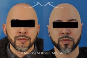 Photo of a patient before and after a procedure. Ear pinning (otoplasty) - to address protubernt ears or prominent ears.