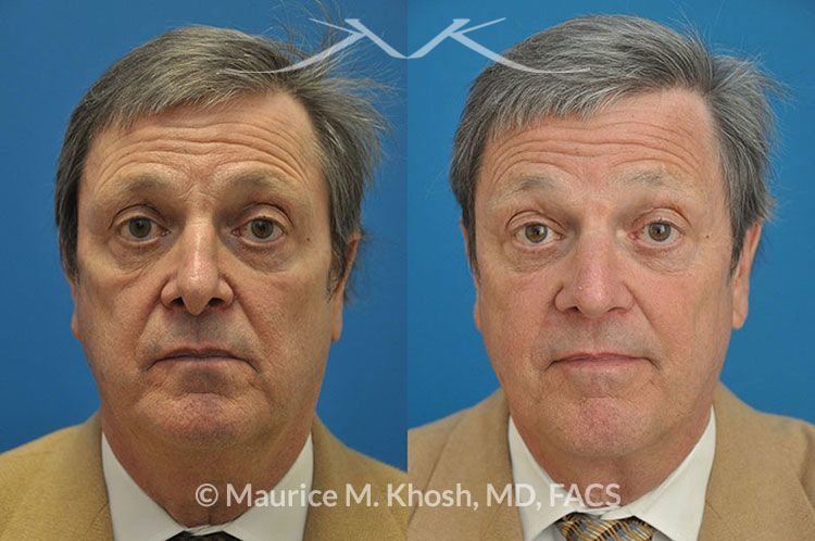 Nasal valve repair New York, NY