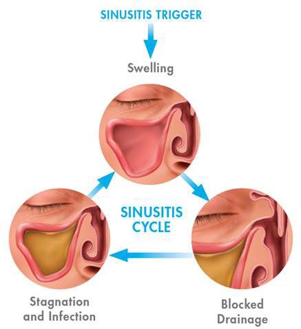 Chart showing sinusitis cycle. Swelling Bloked Drainage and stagnation and infection