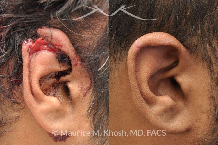 Facial Skin Laceration Repair New York, NY