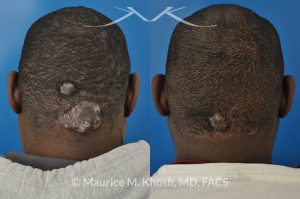 Photo of a patient before and after a procedure. Keloid of scalp - Due to keloid acne.