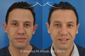 Photo of a patient before and after a procedure. Ear pinning (otoplasty) - for over projected large ears.