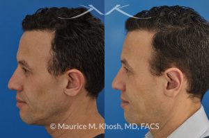 Photo of a patient before and after a procedure. Ear pinning (otoplasty) - for over projected large ears.