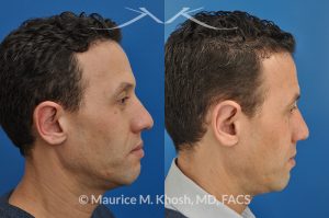 Photo of a patient before and after a procedure. Ear pinning (otoplasty) - for over projected large ears.