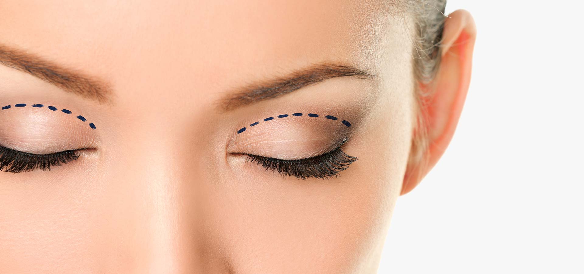 Blepharoplasty, Eyelid Lift Photo Gallery