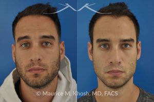 Photo of a patient before and after a procedure. Left sided nasal valve repair with spreader