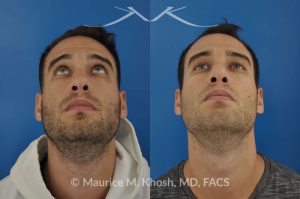 Photo of a patient before and after a procedure. Left sided nasal valve repair with spreader