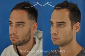 Photo of a patient before and after a procedure. Left sided nasal valve repair with spreader