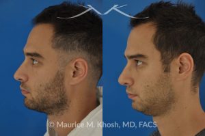 Photo of a patient before and after a procedure. Left sided nasal valve repair with spreader