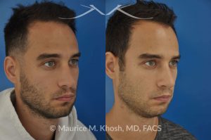 Photo of a patient before and after a procedure. Left sided nasal valve repair with spreader